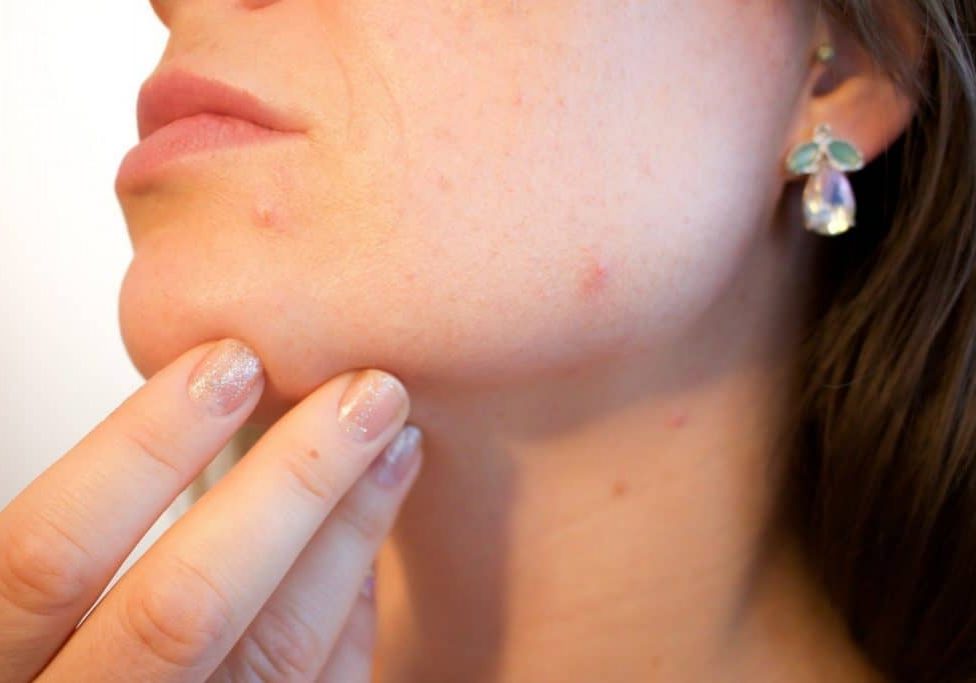 acne-clinica-anglo americana acne-clinica-anglo americana