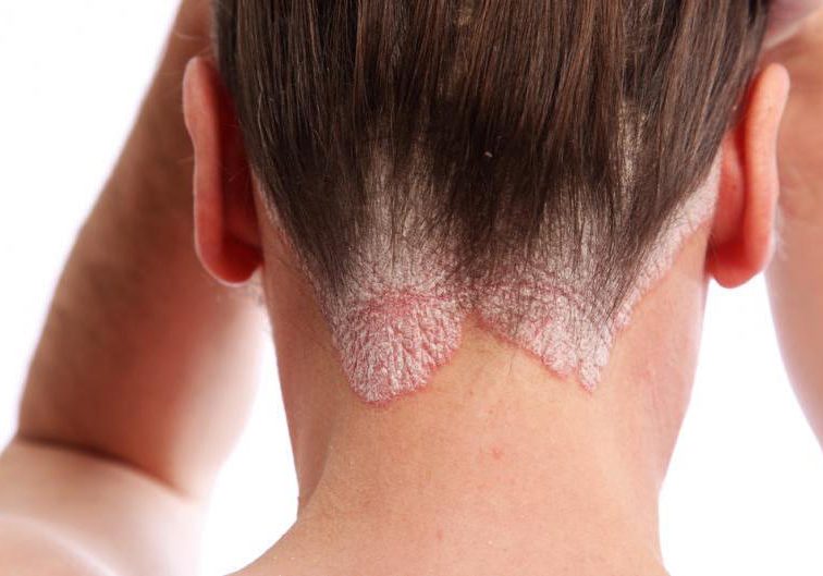 dermatitisseborreica dermatitisseborreica